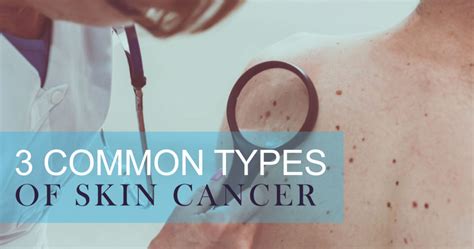 3 Common Types Of Skin Cancer Bardmoor Cancer Center
