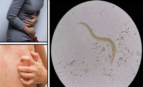 Know The Early Signs That In Human Body Parasites Attacks And How To Prevent Them To Spread