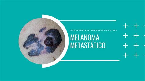 Melanoma Metastático O Que é Sintomas E Tratamento