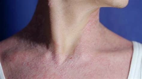 Close Up Shot Of A Man With Psoriasis On The Head Rush Skin Behind The