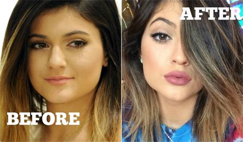 Warning The Kylie Jenner Lip Challenge Has Gone Viral And Its Causing Some Serious Dangers