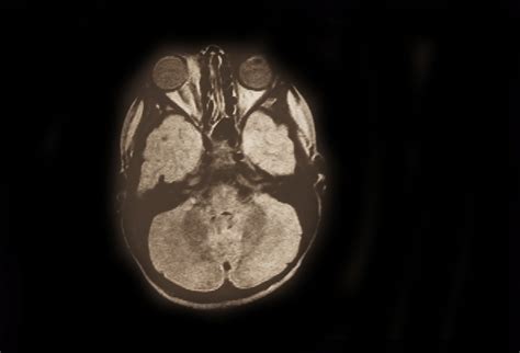 Rhabdomyosarcoma R Orbit - Retina Image Bank