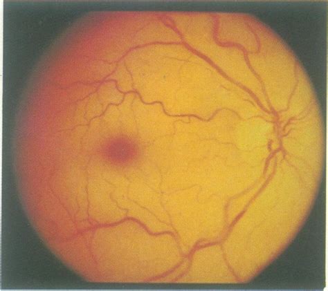 Central Retinal Artery Occlusion Cherry Red Spot