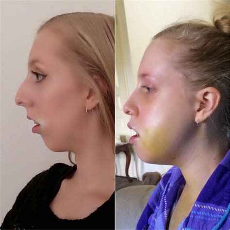 Albums 101 Pictures Jaw Surgery Overbite Before And After Pictures Latest