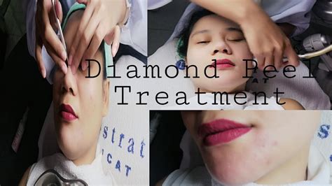 Diamond Peel Treatment Diamondpeeltreatment Skincare Dermstrata