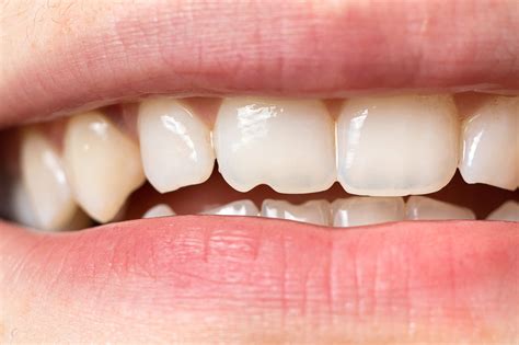 Chipped Tooth Pure Dentistry