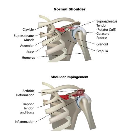 Shoulder Pain Overview Causes And Related Diseases Signs And
