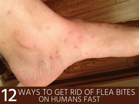 How To Get Rid Of Flea Bites On Humans Fast Flea Bite Remedy