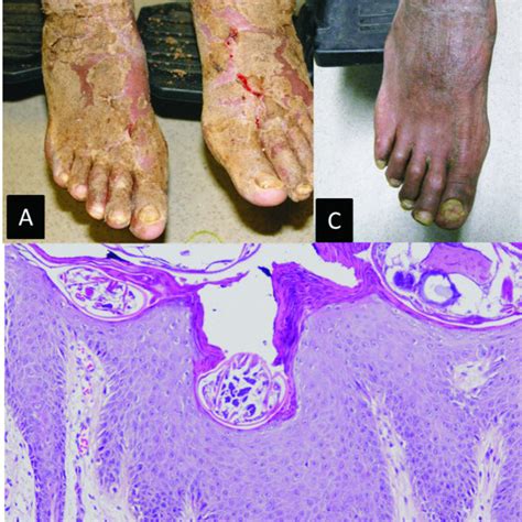 A Hyperkeratotic Hyperpigmented Crusted Plaques With Hemorrhagic