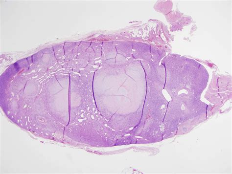 Pseudoxanthoma Elasticum Like Papillary Dermal Elastolysis