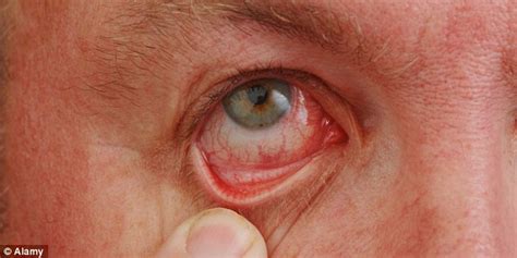 Sore Bloodshot Eyes A Hidden Skin Problem Could Be To Blame Daily