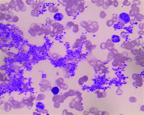 Peripheral Blood Smear Leishman Stained 400× Large Platelet Clumps