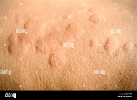 Reazione Allergica Cutanea Immagini E Fotografie Stock Ad Alta