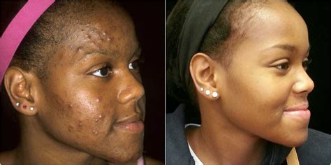 Acne Affects All Ages And Can Be Treated