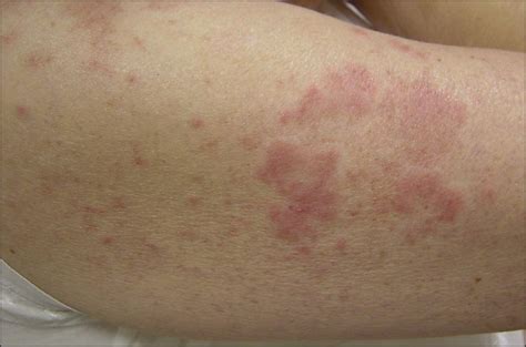 Sweet Like Dermatosis In 2 Patients With Clinical Features Of