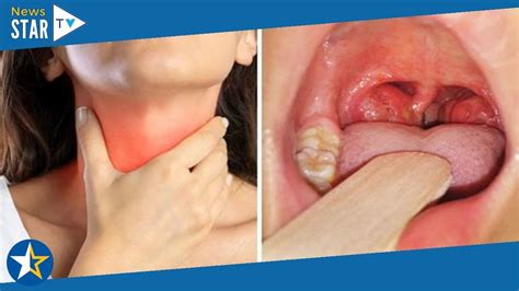 Tonsillitis Symptoms In Adults Can I Go To Work With Tonsillitis