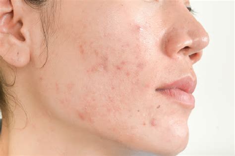 Acne On Cheeks Causes And Cure Glowpink