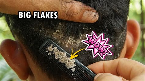 Dry Scalp Flakes