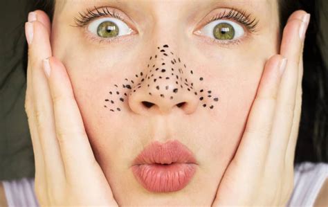 5 Ultimate Tips To Get Rid Of Blackheads