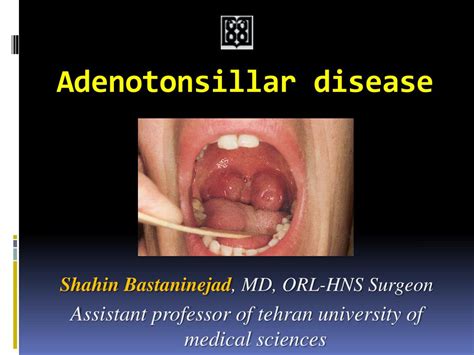 Ppt Adenotonsillar Disease Powerpoint Presentation Free Download