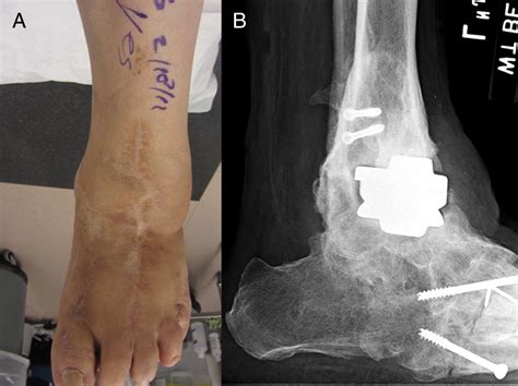 A Modified Anterior Approach To The Ankle The Journal Of Foot And