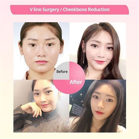 Id Plastic Surgery Hospital Idhospitalkorea Instagram Photos And