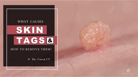 Skin Tags Seborrheic Keratosis And Warts Whats The Difference Dr
