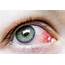 Causes Of Red Eye At Our Jenks OK Optometry Clinic  Insight Eyecare