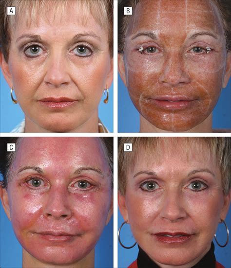 Nitrogen Plasma Skin Regeneration And Aesthetic Facial Surgery Jama