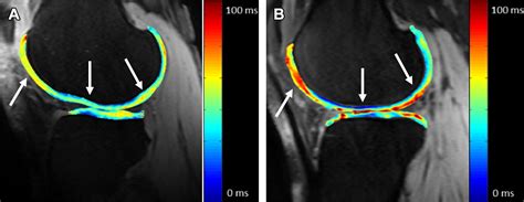 Quantitative Magnetic Resonance Imaging Of The Articular Cartilage Of The Knee Joint Magnetic