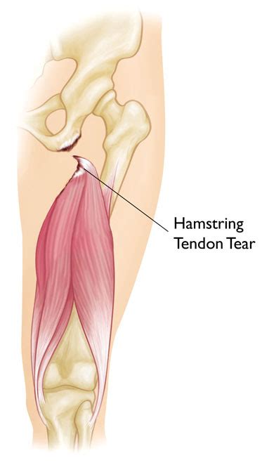 You may have a tendon rupture. Hamstring Muscle Injuries or: Pulled Hamstring ...