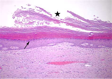 Figure 2 From Giant Epidermal Cyst Of The Gluteal Region Semantic Scholar