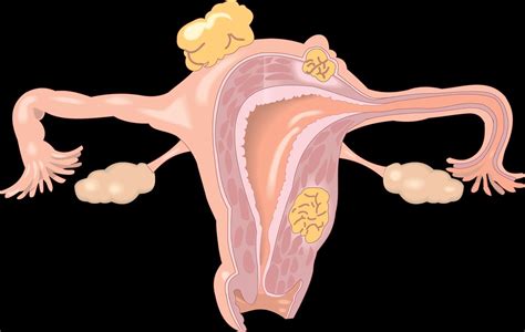 prevención y claves de los tumores pélvicos ginecológicos más frecuentes en la mujer doctor