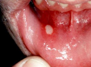 To heal and treat throat burning make a gargling liquid by boiling tamarind fruit. White Sores in Mouth, Causes, Roof, Baby, Open Sore, Bumps ...