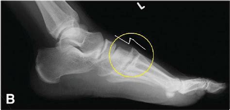 15 A Standard Lateral Radiograph Of A Lisfranc Injury Showing The