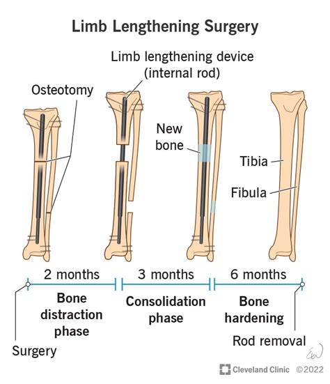 Limb Lengthening Surgery Procedure Process And Recovery