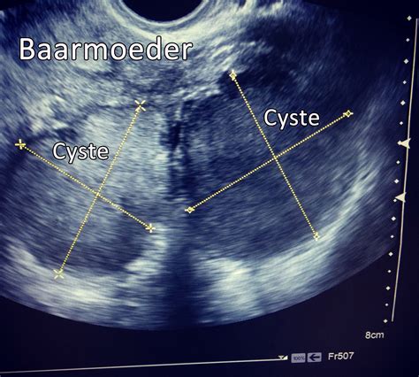 Endometriose Folder Catharina Ziekenhuis