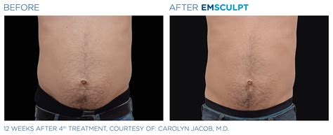 Emsculpt Before And After Photos See Results On Abs And Buttocks