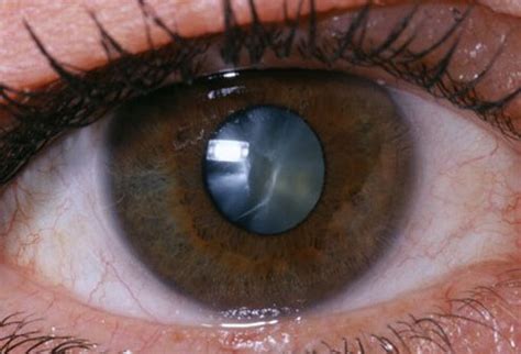 Take the cataract self test. Eye Cataracts: Surgery, Symptoms, Types, Causes & Treatment