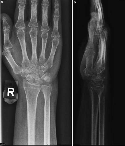 In Osteoporosis Radiology Key