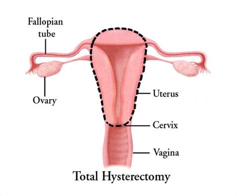 Hysterectomy My Doctor Online