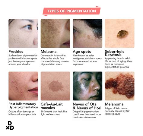 The Complete Guide To Pigmentation Lasers In Singapore 2021 Human