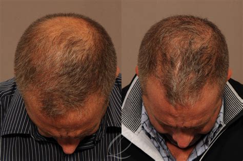 Scarless Hair Transplant In Rochester Ny Fue Quatela Center For Hair Restoration