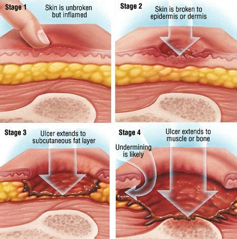 Staging Of Pressure Ulcers Bed Sores