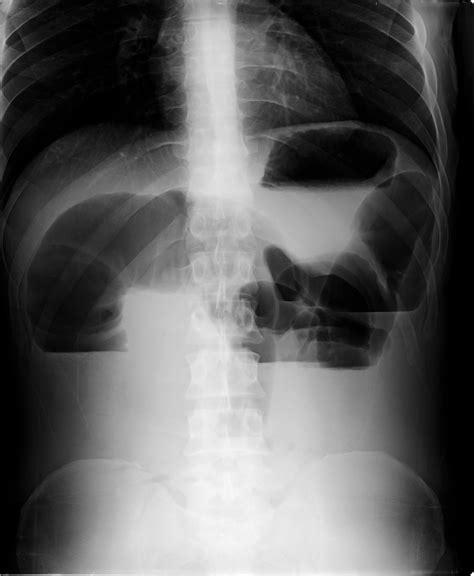 The diagnosis is clinical, confirmed by radiography of the. Small bowel obstruction | Image | Radiopaedia.org