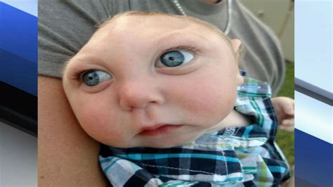 Miracle Baby With Rare Disorder Defies Odds