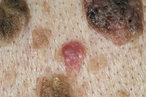 Skin Cancer And Seborrhoeic Warts Stock Image C0213361 Science