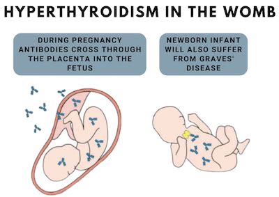 Hyperthyroidism During Pregnancy