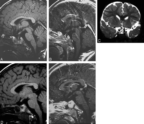 Pituitary Cysts In Childhood Evaluated By Mr Imaging American Journal