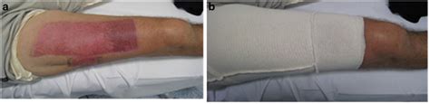 Interim Pressure Garment Therapy 4 6 Mmhg And Its Effect On Donor Site Healing In Burn